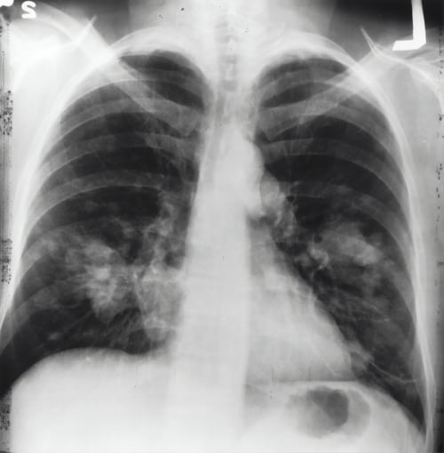 Riconoscere la tubercolosi diagnosi e sintomi