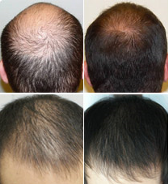 Grow Hair Active - controindicazioni - effetti collaterali