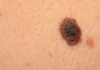 Il melanoma, una malattia della pelle