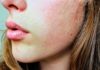 Otto modi per combattere l’acne