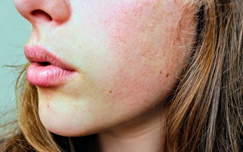 Otto modi per combattere l’acne