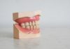 Dente rotto cosa fare quando un dente è rotto o scheggiato
